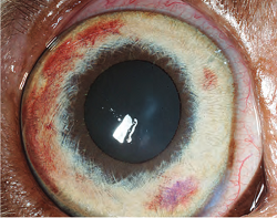 Iris stromal hemorrhage in right eye