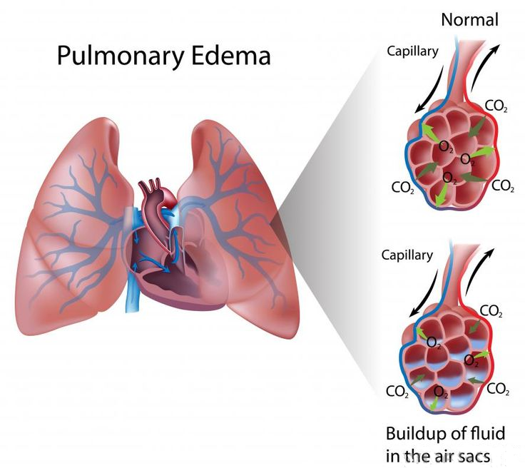 Pulmonary Edema Diagram