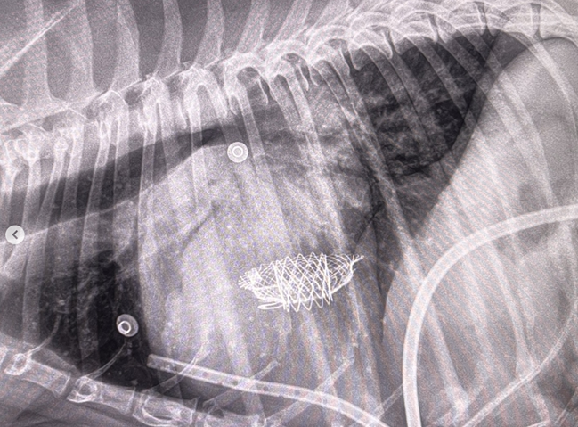 Bioprosthetic mitral valve in place