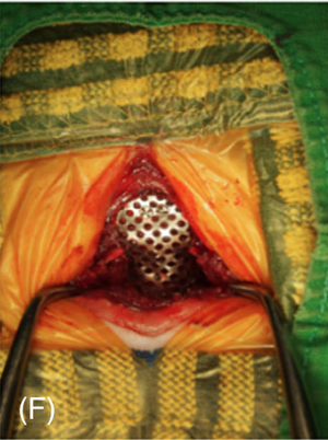 Titanium Mesh FMD Surgery