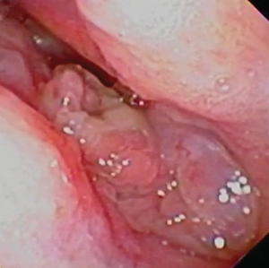 Laryngeal Mass